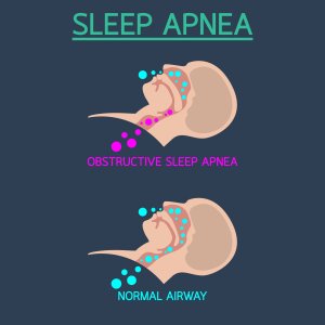 Sleep apnea illustration