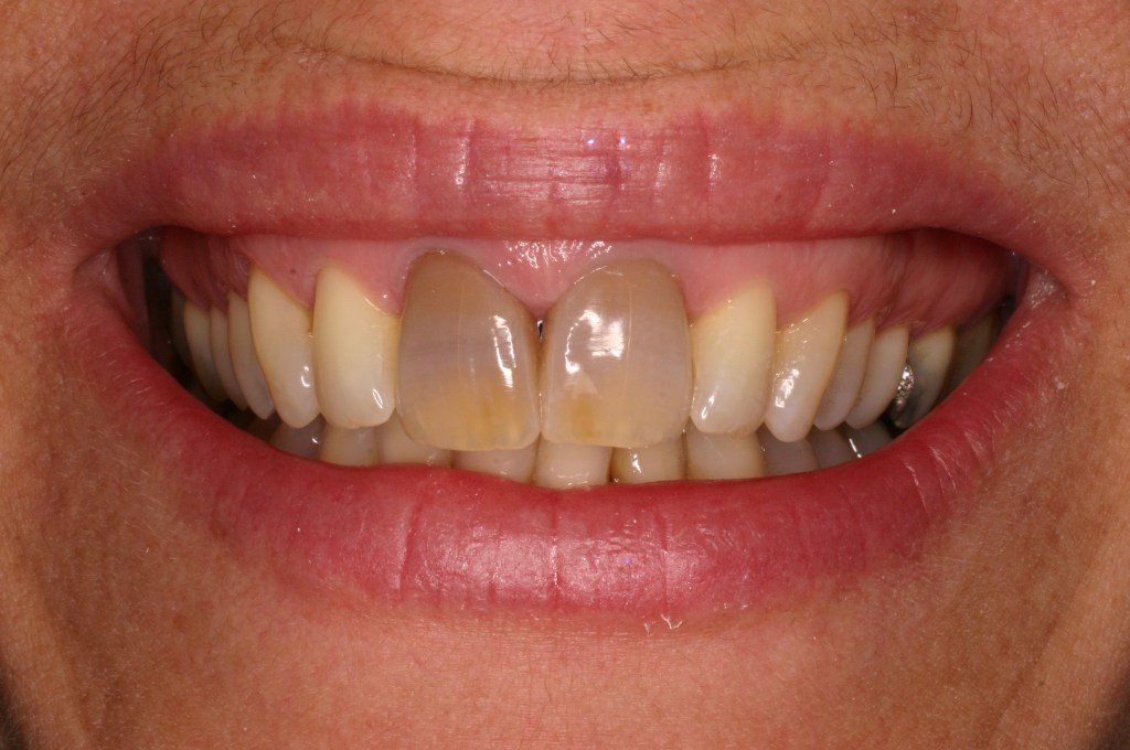 Up close photo of a smile