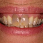 Up close photo of a smile