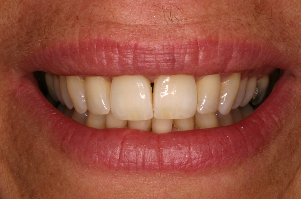 Up close photo of a smile