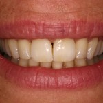 Up close photo of a smile