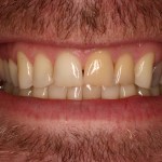 Up close photo of a smile