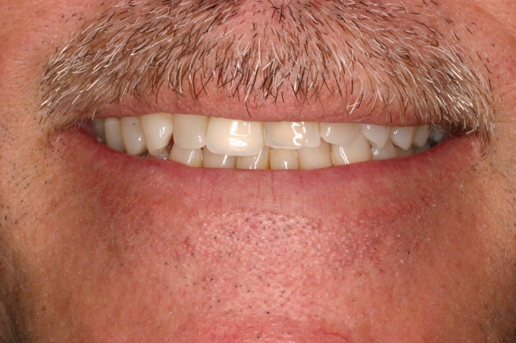 Up close photo of a smile