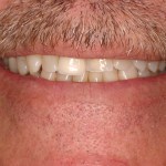 Up close photo of a smile