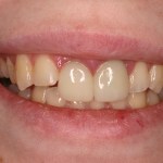 Up close photo of a smile