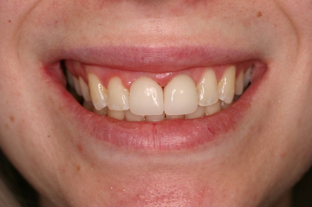 Up close photo of a smile