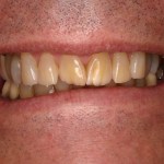 Up close photo of a smile