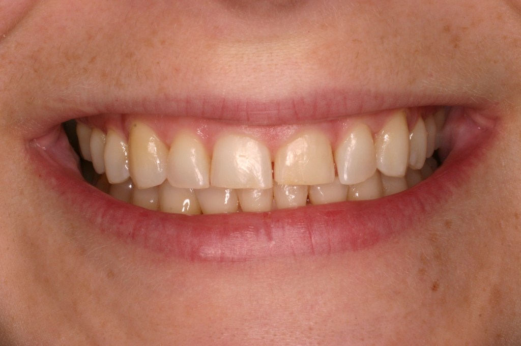 Up close photo of a smile