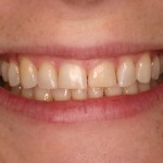 Up close photo of a smile