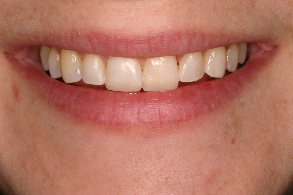 Up close photo of a smile