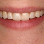 Up close photo of a smile