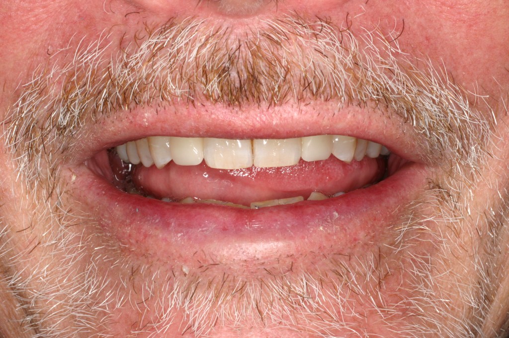 Up close photo of a smile